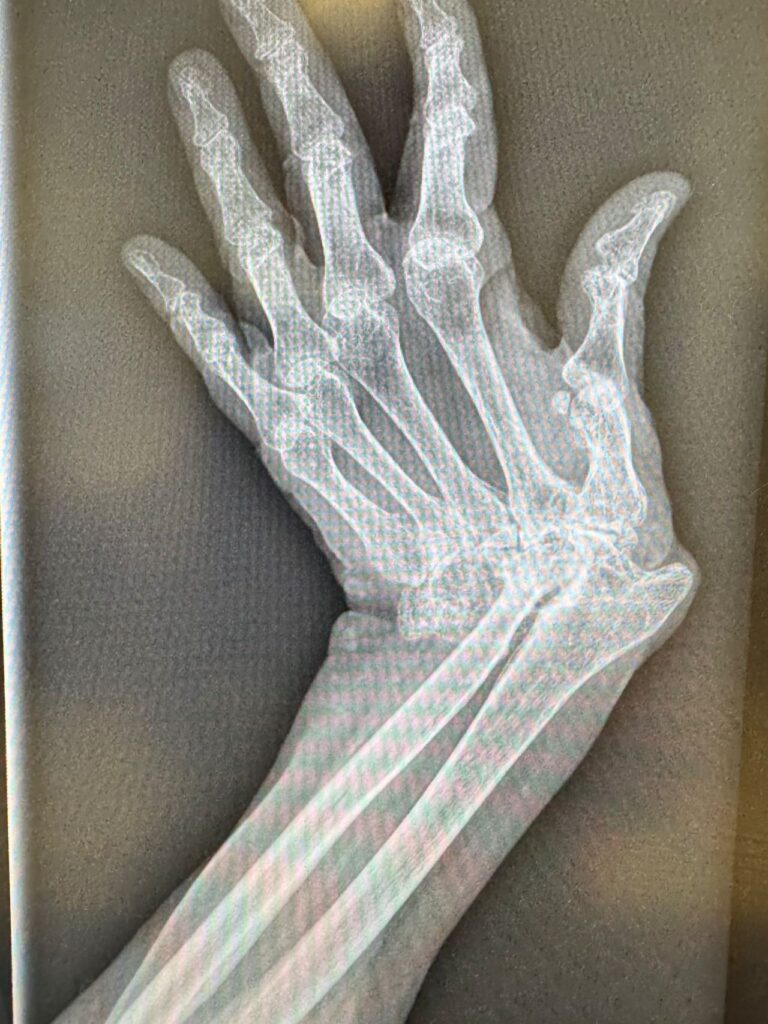 Wrist Reconstruction