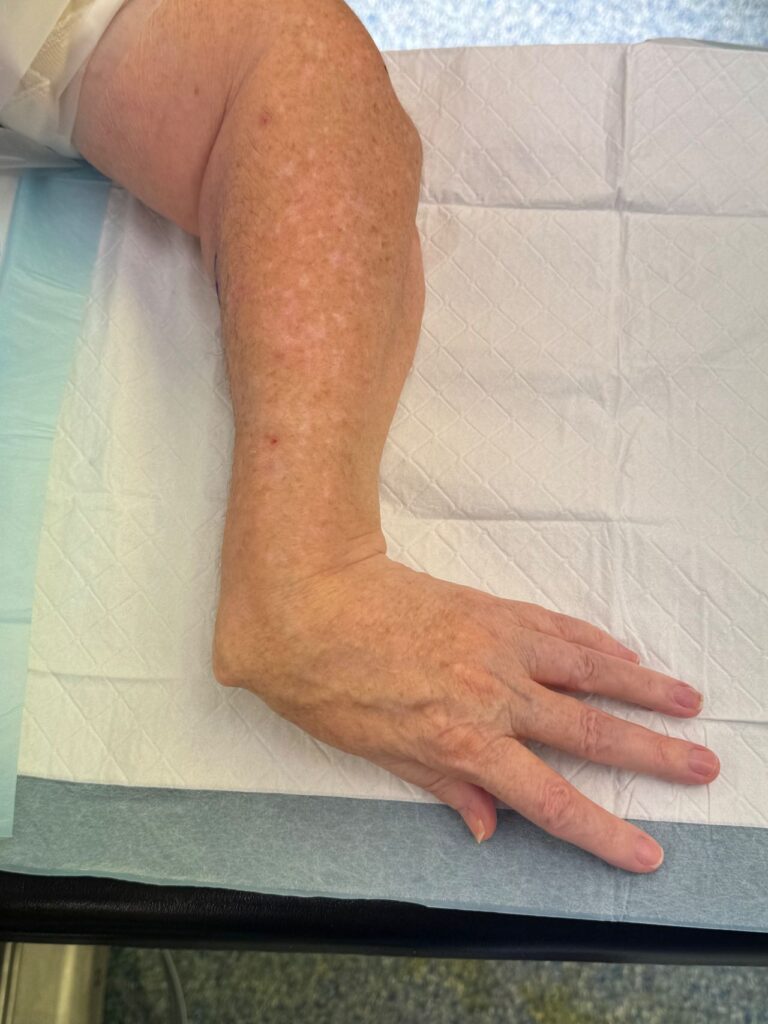 Wrist Reconstruction